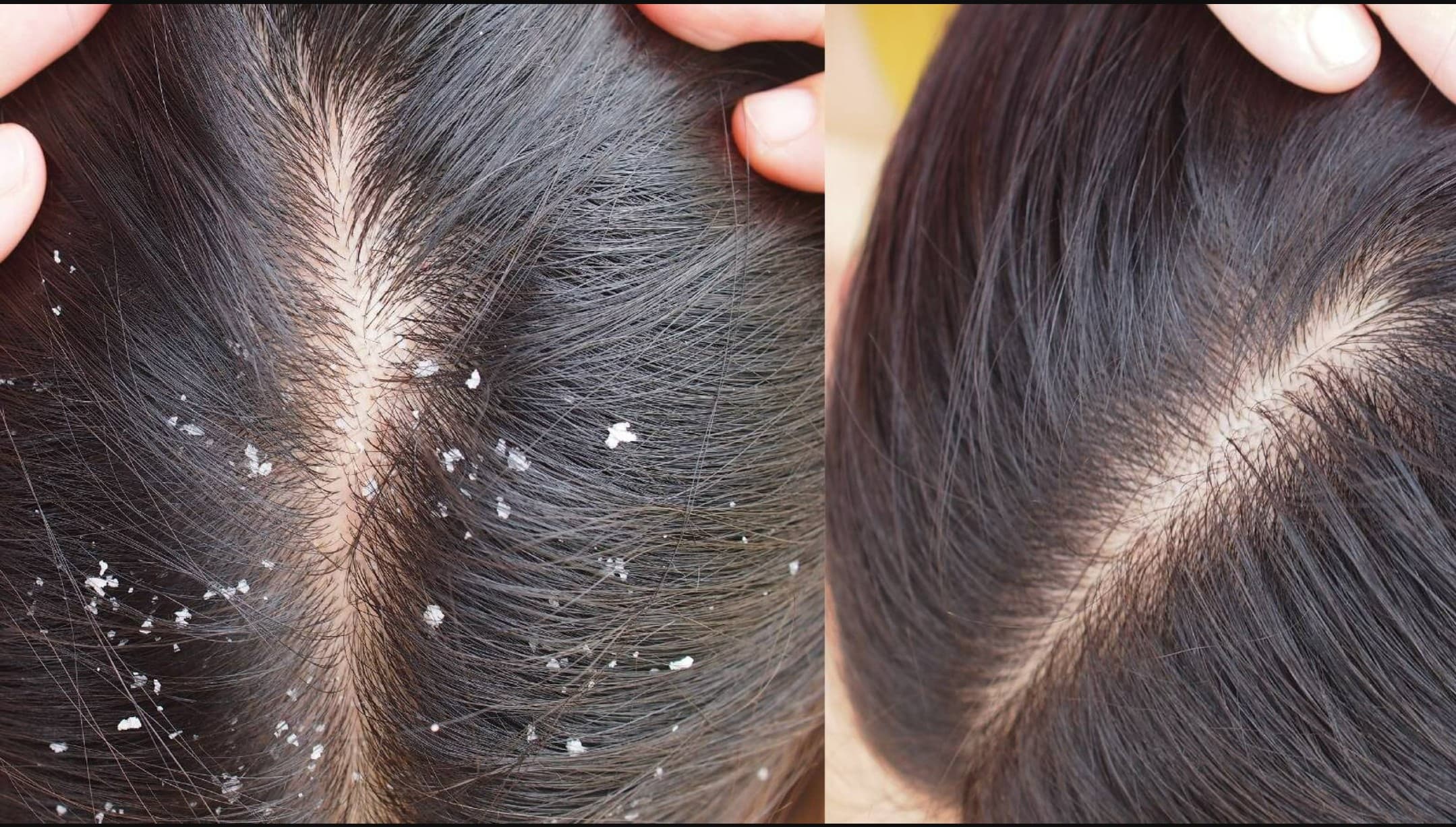 Homemade remedy for dandruff in Hindi: डैंड्रफ को कहें हमेशा के लिए बाय-बाय! अपनाएं ये 5 देसी नुस्खे और पाएं साफ़-सुथरे बाल, वो भी बिना शैंपू के
