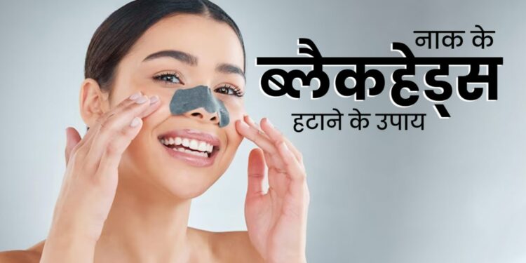 Blackheads Kaise Hataye: ब्लैकहेड्स को जड़ से खत्म करें! इन 5 घरेलू नुस्खों से पाएं साफ और चमकदार त्वचा