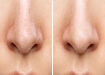 Home remedies to remove blackheads: ब्लैकहेड्स को जड़ से खत्म करें! नाक के काले धब्बों को हटाने के 4 आसान घरेलू नुस्खे, आजमाएं और देखें कमाल!