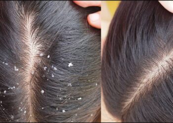 Homemade remedy for dandruff in Hindi: डैंड्रफ को कहें हमेशा के लिए बाय-बाय! अपनाएं ये 5 देसी नुस्खे और पाएं साफ़-सुथरे बाल, वो भी बिना शैंपू के