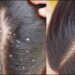 Homemade remedy for dandruff in Hindi: डैंड्रफ को कहें हमेशा के लिए बाय-बाय! अपनाएं ये 5 देसी नुस्खे और पाएं साफ़-सुथरे बाल, वो भी बिना शैंपू के